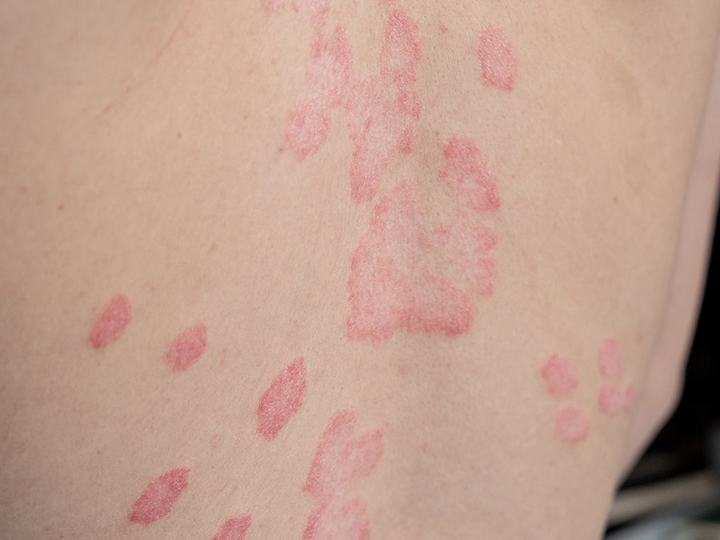 Psoriasis